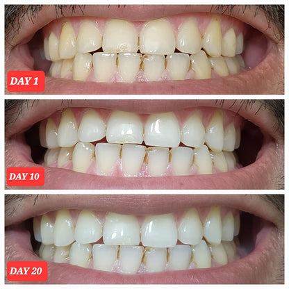RoseGy™ Coconut Teeth Whitening Strips - 7-Day Treatment with Non-Slip, Dry Strip Technology