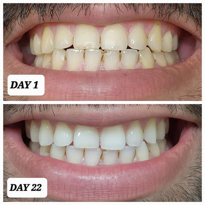 RoseGy™ Coconut Teeth Whitening Strips - 7-Day Treatment with Non-Slip, Dry Strip Technology